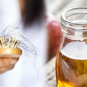 Rambut Rontok? Waspada Penyakit Autoimun Alopecia Areata Rambut Rontok? Waspada Penyakit Autoimun Alopecia Areata