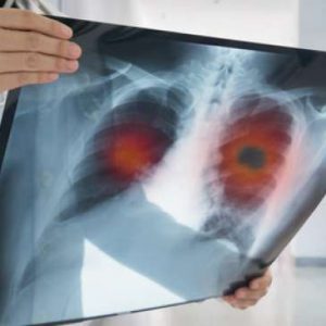 Skrining Kanker Paru untuk Perokok, Seberapa Penting?